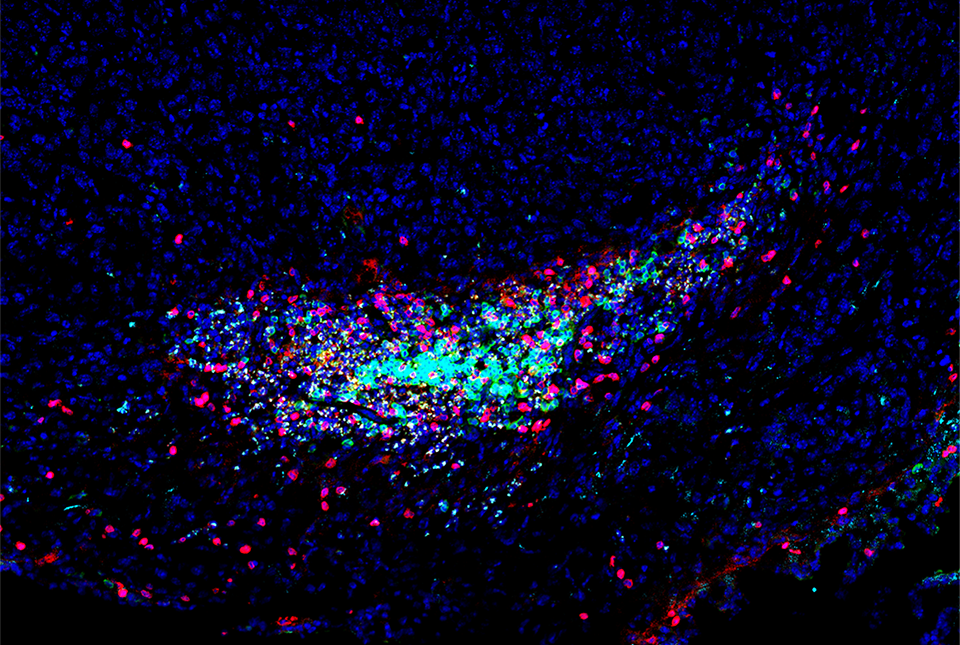 Lyden Cancer Cell