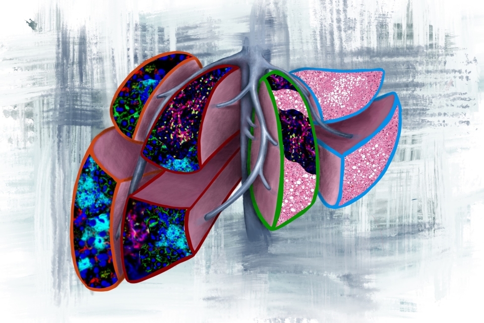 Image illustrating four prognostic scenarios that may be found in liver biopsies when pancreatic cancer is diagnosed before metastasis. (Left to right) Orange: neutrophil extracellular traps (NETs), suggesting liver metastasis in less than 6 months. Red: NETs and T cells, suggesting liver metastasis in greater than 6 months. Green: T cells and fatty liver suggesting metastasis to a different organ. Blue: Normal liver with fatty liver indicating no-evidence of future metastasis. Credit: Vanessa Dudley