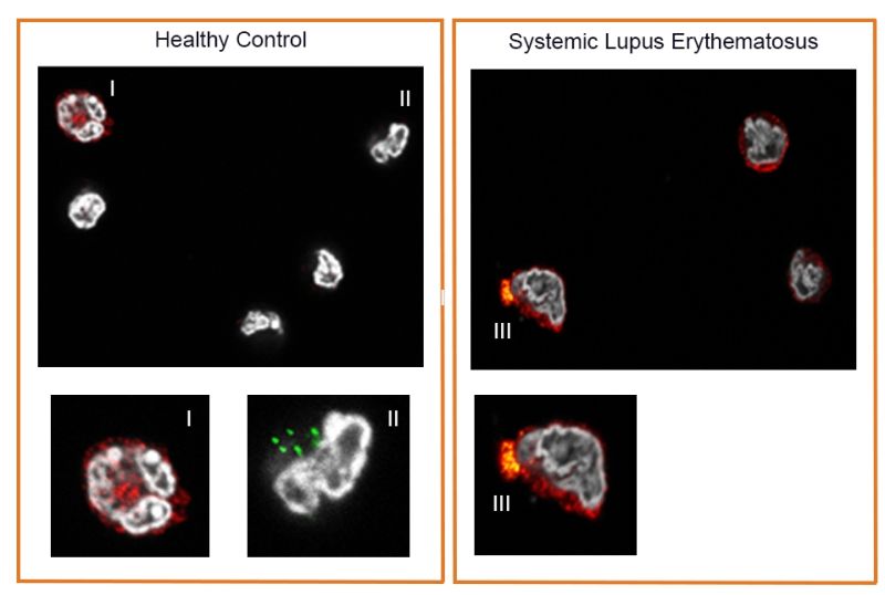 Healthy monocytes express either interferon-sensitive proteins, such as the interferon-inducible protein MxA (red, I) or IL-1b (green, II). SLE blood monocytes (right) co-express both proteins (yellow, III). This abnormal co-expression may explain why treatments targeting only interferons may be inadequate in some patients with lupus. Credit: Dr. Simone Caielli